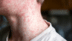 Measles isn't over when the rash fades: 8 critical health problems that can follow the infection