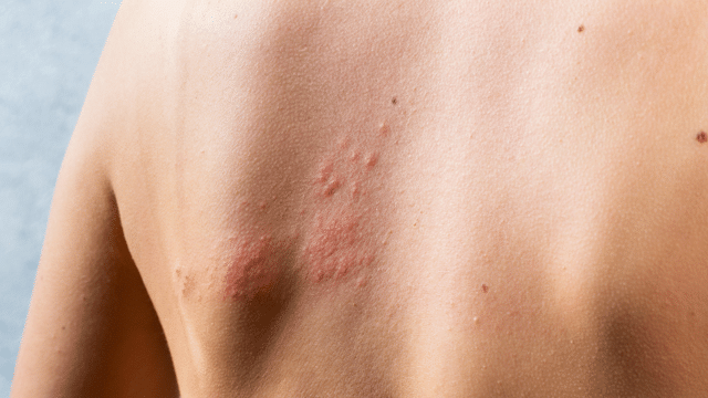 Early symptoms of shingles that you must not ignore