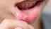 What is oral cancer: Know its symptoms, causes, and why early detection may save your life