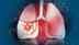 Lifestyle and lung cancer link: How daily choices raise or lower your risk
