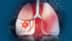Lifestyle and lung cancer link: How daily choices raise or lower your risk