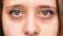 Why do we get dark circles? Common causes and ways to reduce