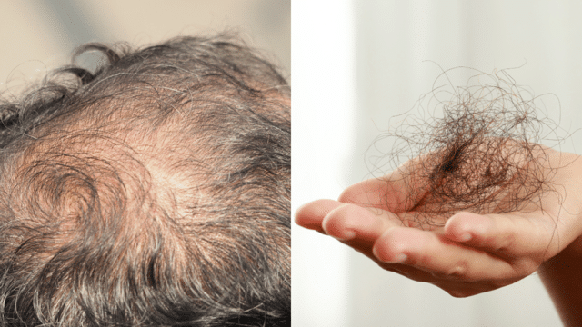 5 serious causes that may be causing hair fall