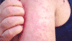 Measles outbreak 2025 in the U.S.: Cases quadruple, near 30-year high—What's really going on?